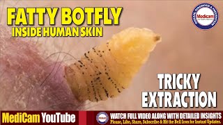 Botfly Larvae Removal Inside Human Skin  How to Extract Botfly Maggots Safely [upl. by Ardelia255]