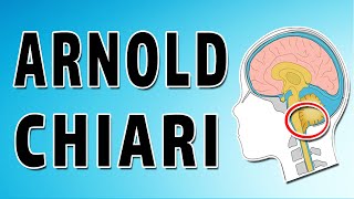 Arnold Chiari Malformations [upl. by Jair]