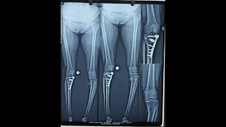 HTO HIGH TIBIAL OSTEOTOMY [upl. by Leban329]