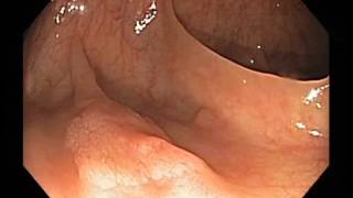 Colonoscopy Channel  Serrated adenoma with intramucosal cancer [upl. by Dowling]