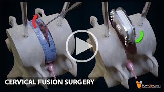 Anterior Cervical Fusion [upl. by Naut]