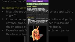 TEE Transgastric Deep long Axis [upl. by Nan544]