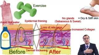 Scleroderma Systemic sclerosis [upl. by Agneta]