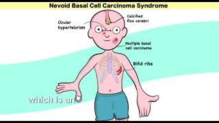 Gorlin syndrome nevoid basal cell carcinoma syndrome  Mnemonic  easy learning [upl. by Ttcos135]