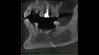 Surgical Removal Of Radicular Cyst By DrAnwar AlAbdullah [upl. by Terrill]