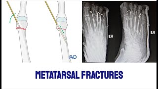 MULTIPLE METATARSAL FRACTURES IN A YOUNG MALE CRIF WITH K WIRES FIXATION AND MOBIISED IMMEDIATELY [upl. by Allimaj]