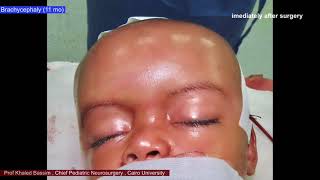 Brachycephaly and communicating hydrocephalus case presentation [upl. by Einram]