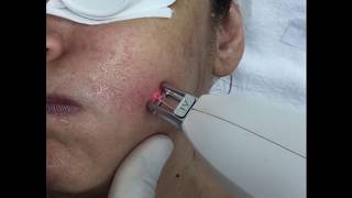 Facial thread veins treatment with FormaTKs 1064nm Nd [upl. by Clara844]