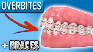 How Do BRACES FIX Overbites  Overbite Before and After Braces  Premier Orthodontics [upl. by Silverts]