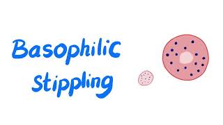 Basophilic Stippling of RBCs  Lead Poisoning  Microscopic Finding  Hematology Labs [upl. by Kulseth]