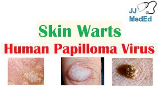 Overview of Skin Warts Verrucae  What Causes Them Who Gets Them  Subtypes and Treatment [upl. by Agle]