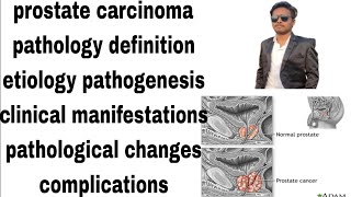 prostate carcinoma  prostate cancer  pathology notes  definitionetiologypathogenesishindi [upl. by Langham]