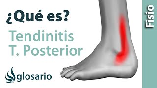 TENDINITIS DEL TIBIAL POSTERIOR  ¿Qué es [upl. by Etennaej]