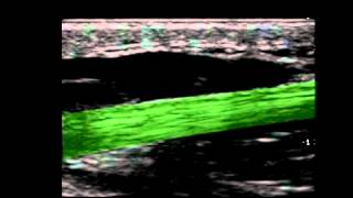 Musculoskeletal Ultrasound Hand 10 thenar longitudinal scan of MCP joint [upl. by Jara592]