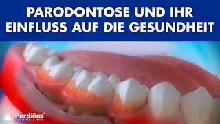 Parodontose und ihr Einfluss auf die Gesundheit © [upl. by Vierno]