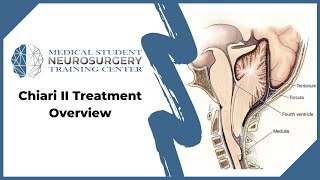 Chiari II Treatment Overview [upl. by Teragramyram]