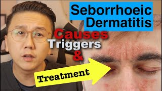 Seborrhoeic Dermatitis  Causes Triggers amp Treatment Options [upl. by Bindman]