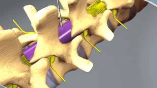 What to expect during an Epidural Steroid Injection at RAYUS [upl. by Sabine]