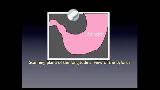 Pyloric Stenosis [upl. by Levins178]