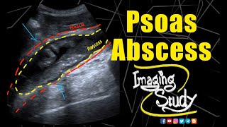 Psoas Muscle Abscess  Ultrasound  Case 231 [upl. by Siron]