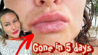 Angular Cheilitis gone in 5 daysLip eczemacracked lips red corners mouth SHOCKING FAST RESULTS [upl. by Amilb]