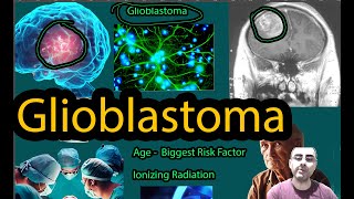 Glioblastoma  Symptoms causes and new hope [upl. by Belloir]