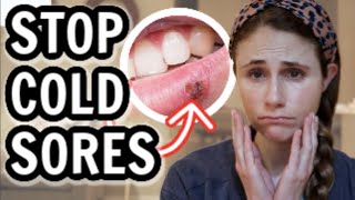 How to treat cold sores FAST Dr Dray [upl. by Abernathy45]