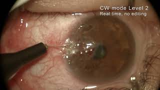 Corneal New Vessels treatment Realtime no editing [upl. by Derej]