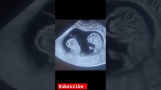 Twins pregnancy in different placenta pregnancysymptoms pregnant mombbaby motivation [upl. by Vizza]