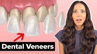 Dental Veneers Procedure Explained [upl. by Loredana]