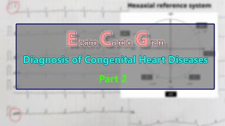 ECG Diagnosis of Congenital heart diseases PART 2 [upl. by Ladew282]