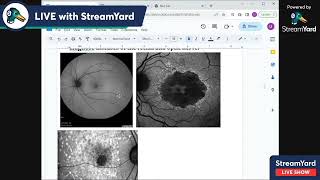 2 papilledema stages cf lab investigations pseudo papilledema [upl. by Asabi]