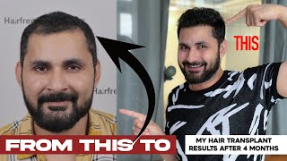 My Hair Transplant Experience after 4 Months  Revealing all secrets of my hair growth  Vlog [upl. by Lemmuela]