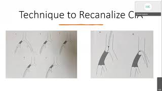 Aortoiliac Disease Endovascular Treatment [upl. by Annabal]