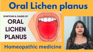 Oral lichen planus treatment  Oral lichen planus symptomscauses amp homeopathic medicine in hindi [upl. by Naujed]