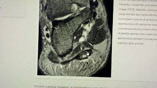 Fibromatosis plantar [upl. by Eentruoc]