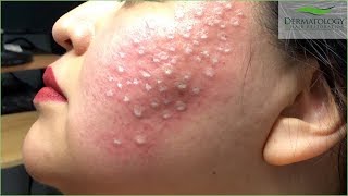 Acne Scar Treatment TCA Cross using TCA 80 [upl. by Newkirk]