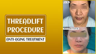 Thread Lift Procedure Explained NonSurgical Facelift for AntiAging  Benefits Types amp Results [upl. by Dasha]