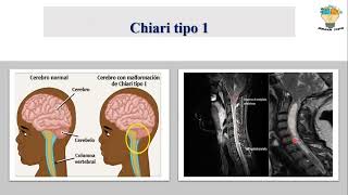 MALFORMACIONES CONGÉNITAS DEL ENCEFALO Hidrocefalia Chiari Craneosinostosis Dandy Walker [upl. by Yelrahc]