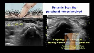 Ultrasoundguided nerve hydrodissection for pain management – Supplementary video 2 ID 247208 [upl. by Leverick]