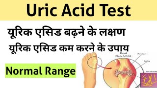 Uric Acid Test in Hindi  uric acid treatment  uric acid symptoms [upl. by Etnoek]