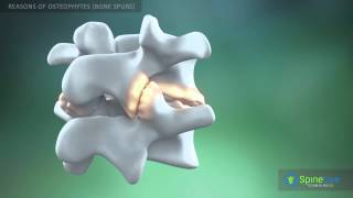 Osteophytes bone spurs Reasons [upl. by Ayikan]