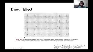 Digoxin Toxicity [upl. by Elok]