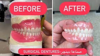 MAKING OF DENTURES 4K  صناعة دينچر بروس WAXBAE DENTURES [upl. by Margaretha]