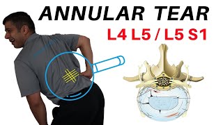 Annular Tear L4L5 L5S1 Disc Bulges [upl. by Ahteral139]