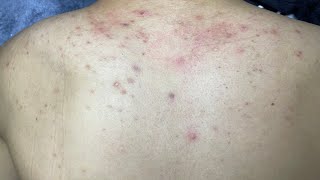 ACNE TREATMENT VU QUYNH MI  Acne On Back FULL [upl. by Enelkcaj]