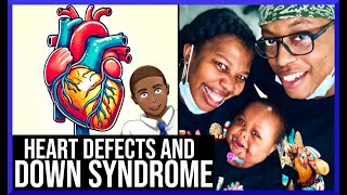 Managing Congenital Heart Defects in Down Syndrome Kids [upl. by Atcele]