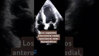 Hipoquinesia anterolateral medial y apical echocardiogram hipoquinesia akinesia infarto [upl. by Hnao715]