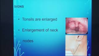 Chronic tonsillitis  To operate or not   English  Patient teaching programme [upl. by Senalda352]