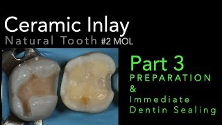 Lithium Disilicate Ceramics Part 3 Preparation and Immediate Dentin Sealing IDS [upl. by Hein]